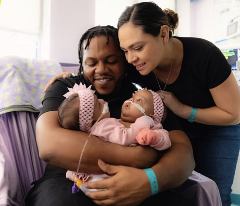 Over 50 doctors successfully separate conjoined Arciniega twins in historic surgery